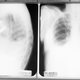 X-ray images showing an internal pacemaker in 1962